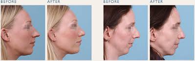 We did not find results for: Cosmetic Rhinoplasty Mr Julian Rowe Jones Aesthetic Rhinoplasty