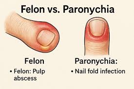 Image result for Felon