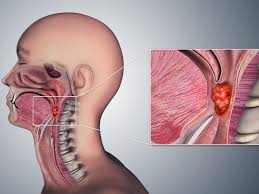 Partners of someone with hpv related mouth/throat cancer do not have an increased rate of oral hpv infection. Less Treatment For Hpv Related Oropharyngeal Cancer National Cancer Institute