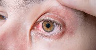 Conjunctivitis Pink Eye A Common Fall Illness