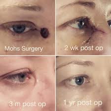 Mohs surgery has the highest cure rates for skin cancer and keeps defects as small as possible by removing the smallest amount of normal skin possible. Skin Concerns One Year Post Mohs Surgery For Basal Cell Carcinoma Skincareaddiction