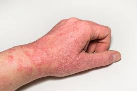 Image result for Eczema nummulare