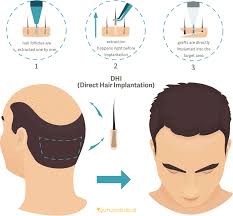 Dhi Vs Fue Hair Transplant Procedures Explained Hair Transplant Procedure Hair Transplant Aesthetic Dermatology
