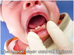 Image result for Neonatal Teeth