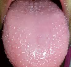 Cara rawat bengkak tonsilvideo ini menjelaskan cara rawat bengkak tonsil dengan dengan home remedies dari rumah & dengan supplemen shaklee iaitu nutriferon. Anak Kena Tonsil Sampai Cirit Birit Hampir 2 Minggu Ibu Cuba Petua Buah Tin Legakan Bengkak Tonsil Pa Ma