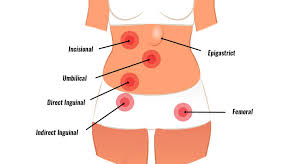 Image result for stomach hernia symptoms