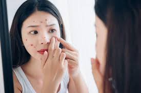 Nyamuk penyebab kedua penyakit itu jenisnya berbeda. Jenis Penyakit Kulit Dibedakan Dari Yang Menular Dan Tidak Menular