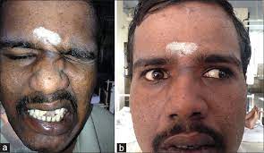 Check spelling or type a new query. A Rare Cause Of Twelfth Nerve Palsy Guillain Barre Syndrome Eswaradass Pv Ramasamy B Kalidoss R Gnanashanmugham G Arch Med Health Sci
