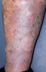 Some skin cancers (as a cream) how fluorouracil works. Lower Leg Of Our Patient 5 Months After 5 Fluorouracil Therapy Download Scientific Diagram