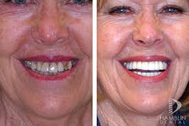 Dental Implants Utah