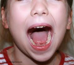 Hypoplasie du condyle gauche chez un enfant de 7 ans/orthodontiste Québec