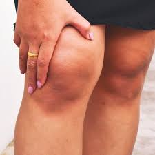 Pin On Varicose Veins Blood Circulation Blood Clots Edema Sepsis Vascular Disease