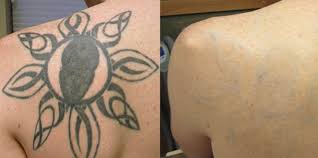 How does tattoo removal work? Best Laser Tattoo Removal Mississauga And Toronto Sama Medspa