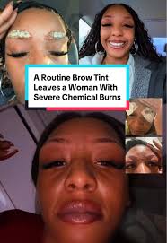 Allergic Reaction to Tinted Eyebrows