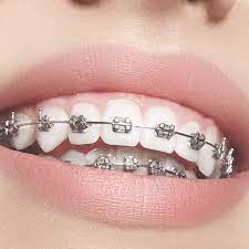When the procedure is completed, you will be free to leave. You Got Your Braces Off Know What To Expect And What To Do