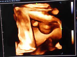 Selanjutnya di hasil usg usia kehamilan 20 minggu, anda mulai bisa melihat jantung janin, mata, hidung, kaki, tulang belakang, dan jenis kelamin. Terbaru 50 Gambar Usg 2 Dimensi Bayi Laki Laki