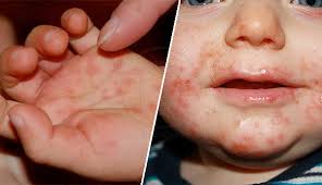 Itu sebabnya, gejala yang muncul biasanya sulit dikenali. 4 Jenis Demam Yang Meninggalkan Ruam Di Badan Ibu Bapa Perlu Berjaga Jaga Bidadari My