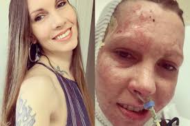 Fundraiser for Alexa Petroff by Barabara Kelly : Alexa's Burn Recovery Fund