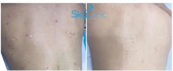 How to get rid of acne scars: Back Acne Scar Treatment Sky Clinic