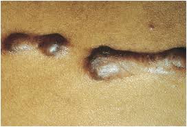 Image result for Keloid