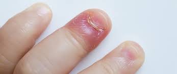 صديد تحت الظفر معلومات تهمك ويب طب