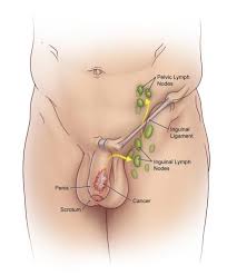 Penile Cancer