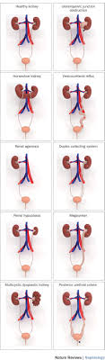 Genetic Environmental And Epigenetic Factors Involved In Cakut Nature Reviews Nephrology