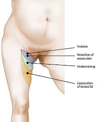 We did not find results for: Thigh Inner Side Lifting Fv Hospital