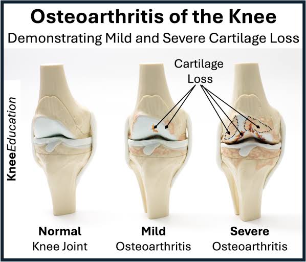 Arthritis vs. Ligament Injury: How to Tell the Difference