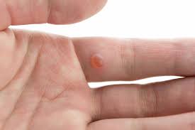 The main method recommended for treating a wart with apple cider vinegar is fairly simple. How To Remove Warts With Apple Cider Vinegar Well Being Secrets