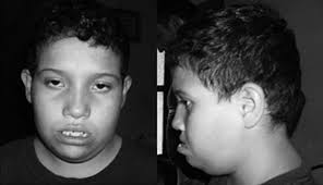 49, XXXXY: Un cariotipo poco frecuente, a propósito de un caso. 49, XXXXY:  A seldom frequent karyotype concerning a case.