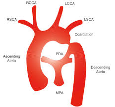 Off meaning, definition, what is off: Coarctation Of The Aorta Sciencedirect