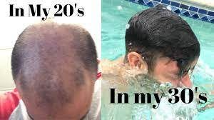 That if pattern hair loss runs in the family, the daughters are most certainly at risk too. One Thing I Would Have Used In My 20 S For Hair Loss Youtube