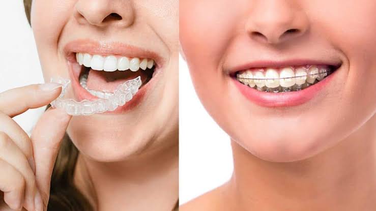 Reveal What Are Ceramic Braces Benefits, Pros/Cons & Costing