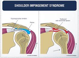 Anatomy and physical examination of the shoulder. Shoulder Impingement Syndrome Full Function Rehab