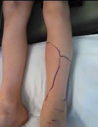 Image result for Envenomation