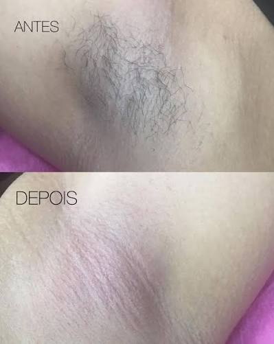 ANTES E DEPOIS DE UMA DEPILAÇÃO NA AXILA   FIQUE LIVRE DOS PELOS . . . . .  . . #axilas #depilação #cera #estetica