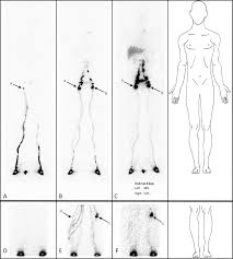 Scintigraphic Investigations Of The Deep And Superficial Lymphatic Systems In The Evaluation Of Lower Limb Oedema Scientific Reports