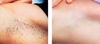 Compare photos, reviews, prices, menus & opening hours. Laser Hair Removal Melbourne Collins Cosmetic Clinic