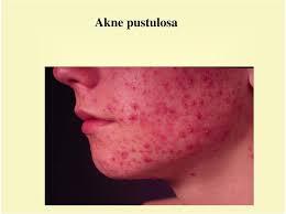 Not to be confused with dioxin or digitoxin. Akne Rosazea Rosazeaartige Periorale Dermatitis Prof Dr M Junger Dr A Ladwig Dr A Arnold Pdf Free Download