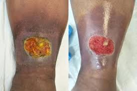 Jika terluka, amat sukar untuk sembuh. Bahaya Luka Kaki Pesakit Diabetes Kalau Kena Potong Jangan Putus Asa Famili Mstar