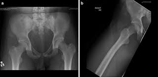 Image result for Pubic Apophysitis