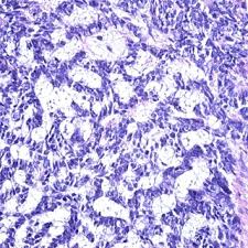 Am fost operat de cancer la corzile vocale pe 5 iulie 2012 de catre dna dr. Sorin Parasca Doctor Of Medicine Carol Davila University Of Medicine And Pharmacy Bucharest Umf Cd Chirurgie Plastica Si Reconstructiva