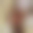 Image result for Bartholin's gland abscess