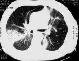 Pneumopathie Cryptogenetique Organisee Troubles Pulmonaires Edition Professionnelle Du Manuel Msd