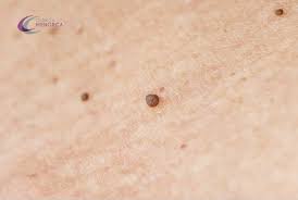 Tratamientos Para Eliminar Las Verrugas En El Cuello