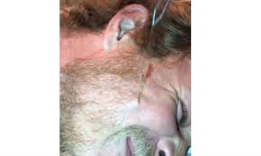 Check spelling or type a new query. Gross Super Long Ingrown Hair Removed New Pimple Popping Videos