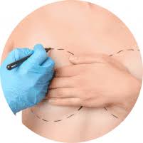 The phalloplasty is a common surgical choice for transgender and nonbinary people interested in gender confirmation surgery. Faloplastia Guadalajara Mexico Faloplastia Lipoescultura Guadalajara