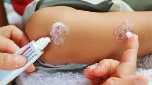 Related:triple antibiotic ointment cream triple antibiotic cream antibiotic ointment neosporin. How To Get Rid Of Impetigo Treatment Options Everyday Health
