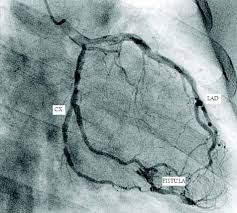 We did not find results for: Coronary Fistulas A Case Series Nada Fennich Fedoua Elouali Ghita Saghi Nadia Bouzammour Leila Haddour Jamila Zarzur And Mohamed Cherti Doi 10 5001 Omj 2014 13 Department Of Cardiology B Ibn Sina Hospital Rabat Morocco Personnel